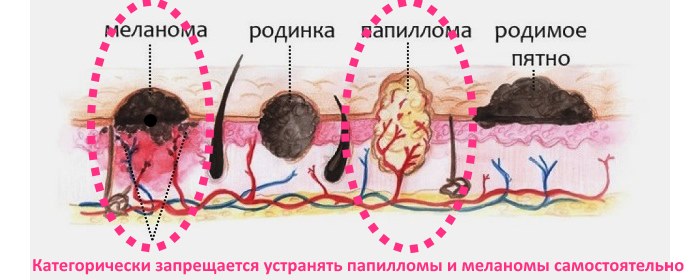 Élimination des grains de beauté au laser, méthode chirurgicale, à domicile. Conséquences, combien de temps la plaie guérit, cicatrices