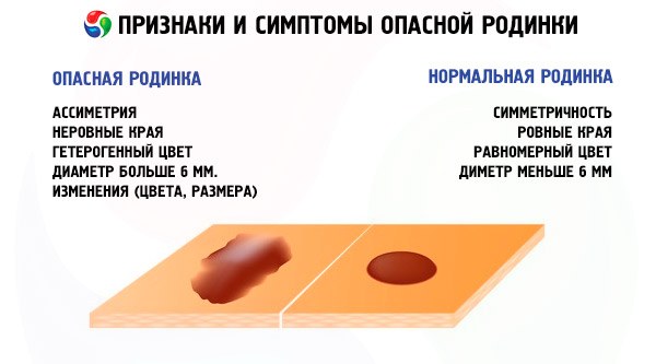 Élimination des grains de beauté au laser, méthode chirurgicale, à domicile. Conséquences, combien de temps la plaie guérit, cicatrices