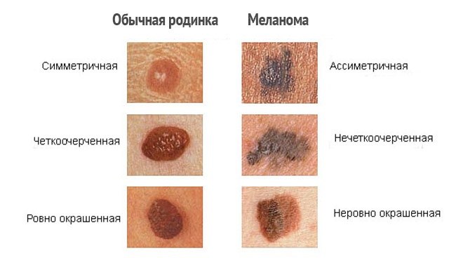 Élimination des grains de beauté au laser, méthode chirurgicale, à domicile. Conséquences, combien de temps la plaie guérit, cicatrices