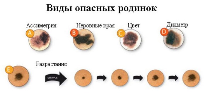 Élimination des grains de beauté au laser, méthode chirurgicale, à domicile. Conséquences, combien de temps la plaie guérit, cicatrices