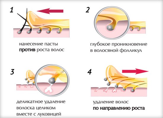 Comment se débarrasser des poils du visage chez les femmes - produits et procédures, enlever avec du fil, de la crème, du laser