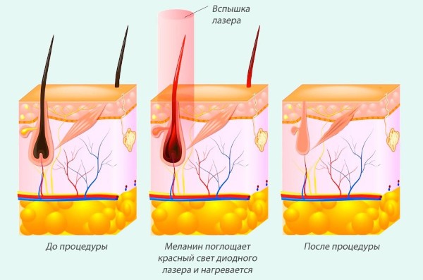 Comment se débarrasser des poils du visage chez les femmes - produits et procédures, enlever avec du fil, de la crème, du laser