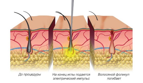 Comment se débarrasser des poils du visage chez les femmes - produits et procédures, enlever avec du fil, de la crème, du laser