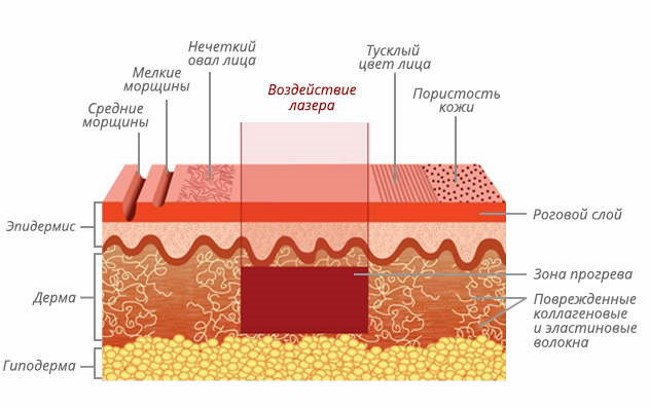 Rajeunissement fractionné - qu'est-ce que c'est, les avantages et les inconvénients de la peau du visage, des critiques