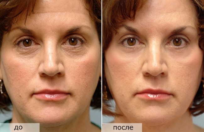 Rajeunissement fractionné - qu'est-ce que c'est, les avantages et les inconvénients de la peau du visage, des critiques