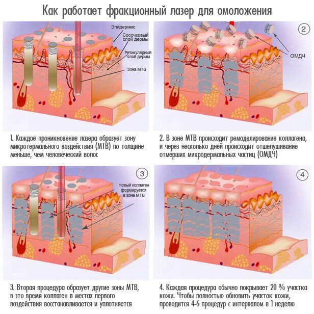 Rajeunissement fractionné - qu'est-ce que c'est, les avantages et les inconvénients de la peau du visage, des critiques