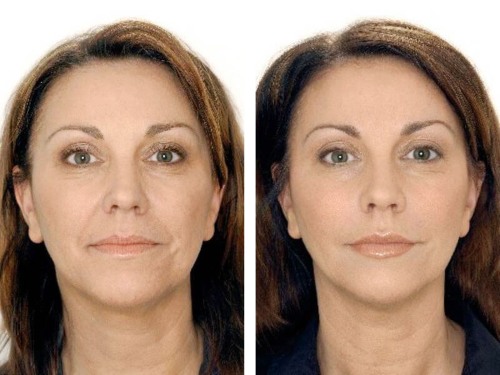 Qu'est-ce que le botox pour le visage, les injections, les injections de nano botox dans le front, les plis nasogéniens, les aisselles