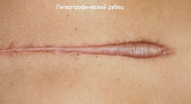 Cicatrices chéloïdes après la chirurgie - qu'est-ce que c'est et pourquoi sont-elles dangereuses? À quoi ressemblent les cicatrices chéloïdes. Une photo