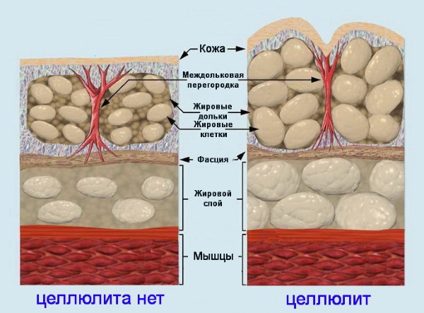 Massage anti-cellulite à domicile. Comment faire pour perdre du poids sur l'abdomen, les jambes, les fesses et d'autres parties du corps. Instructions étape par étape avec photo