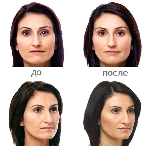 Acide hyaluronique pour le visage: mode de réalisation des injections, résultats, photos avant et après les injections, avis