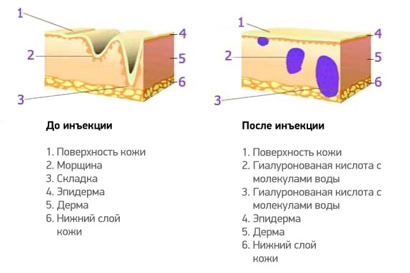 Acide hyaluronique pour le visage: mode de réalisation des injections, résultats, photos avant et après les injections, avis