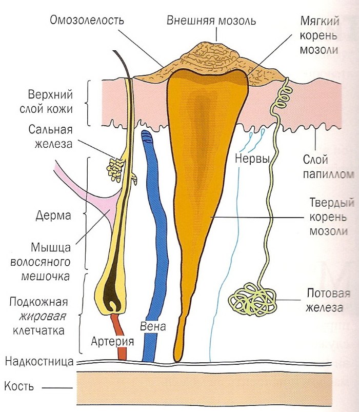 Callosités sur les jambes - comment traiter à la maison avec des remèdes populaires, des pommades, des crèmes, du plâtre