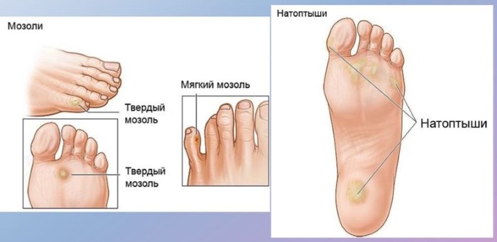 Callosités sur les jambes - comment traiter à la maison avec des remèdes populaires, des pommades, des crèmes, du plâtre