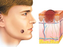 Taupes sur le corps et le visage. Raisons de l'apparence, types, qui sont dangereux et non dangereux, photos, comment les supprimer et si cela est possible