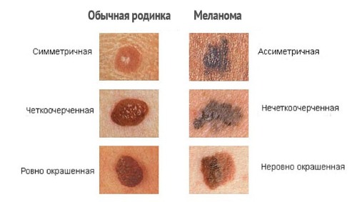 Taupes sur le corps et le visage. Raisons de l'apparence, types, qui sont dangereux et non dangereux, photos, comment les supprimer et si cela est possible