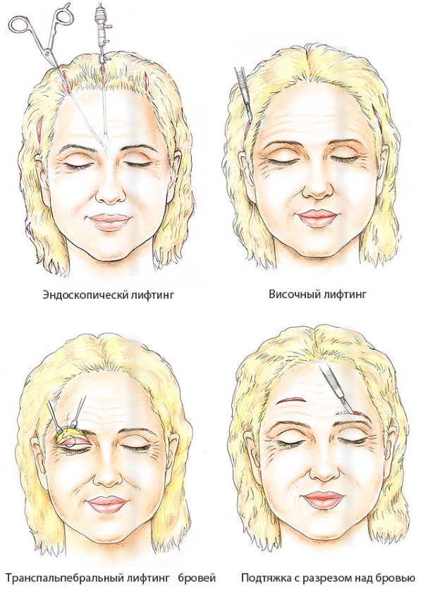 Lifting SMAS - nettoyage du visage par ultrasons. Caractéristiques de la procédure, indications, contre-indications, effet attendu, photo