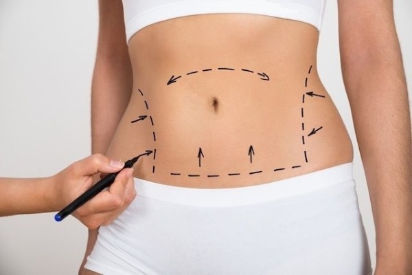 Abdominoplastie de l'abdomen. Quelle est cette opération, comment se fait-elle, photos avant et après, indications et contre-indications, conséquences