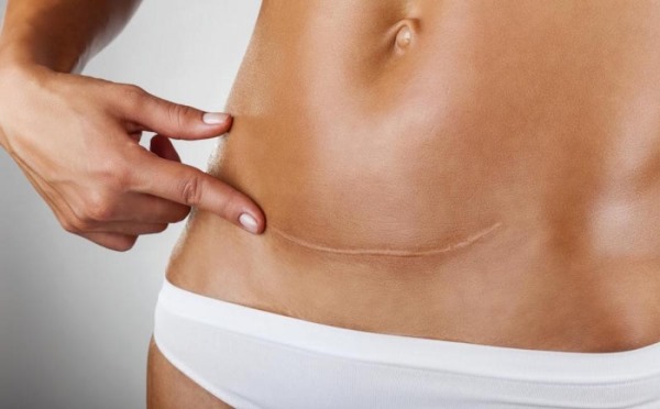 Abdominoplastie de l'abdomen. Quelle est cette opération, comment se fait-elle, photos avant et après, indications et contre-indications, conséquences