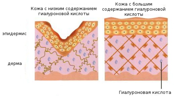 Acide hyaluronique pour le visage en injection pour préparations injectables. Quels médicaments sont meilleurs, comment les appliquer, comment cela fonctionne, les résultats, les photos avant et après, le prix dans une pharmacie