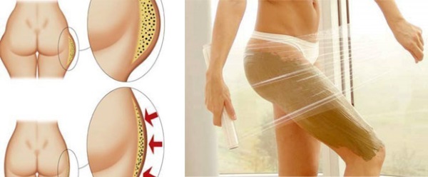 Comment se débarrasser rapidement de la cellulite sur les fesses et les jambes: enveloppements, massages, exercices