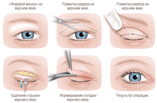 Comment se débarrasser du siècle imminent chez soi. Méthodes traditionnelles, procédures cosmétiques, chirurgie, crèmes et pommades