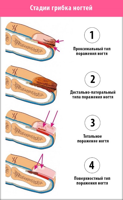 Comment renforcer les ongles avec du gel sous vernis gel. Quels gels sont les meilleurs à utiliser, comment la procédure se déroule étape par étape. Instruction avec photo