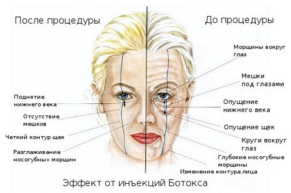 Anatomie des muscles faciaux humains en cosmétologie pour les injections de botox. Schémas avec descriptions et photos en latin et en russe