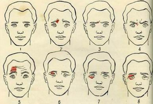 Anatomie des muscles faciaux humains en cosmétologie pour les injections de botox. Schémas avec descriptions et photos en latin et en russe