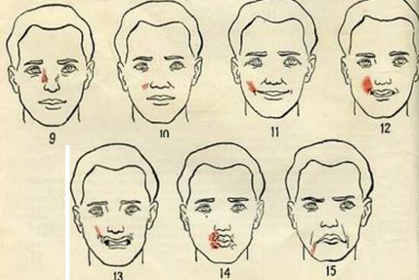 Anatomie des muscles faciaux humains en cosmétologie pour les injections de botox. Schémas avec descriptions et photos en latin et en russe