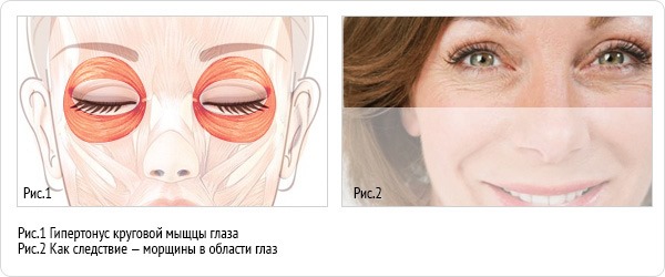 Anatomie des muscles faciaux humains en cosmétologie pour les injections de botox. Schémas avec descriptions et photos en latin et en russe