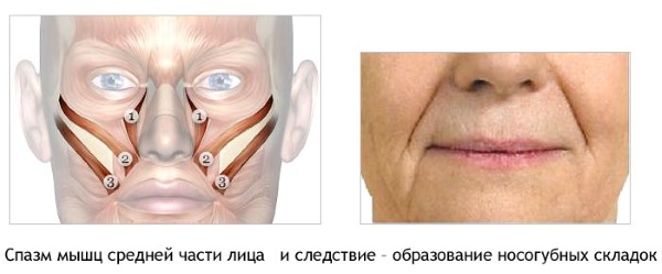 Anatomie des muscles faciaux humains en cosmétologie pour les injections de botox. Schémas avec descriptions et photos en latin et en russe