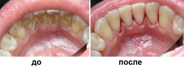 Brosse à dents à ultrasons. Avantages et inconvénients, avis des médecins, évaluation des meilleurs et contre-indications