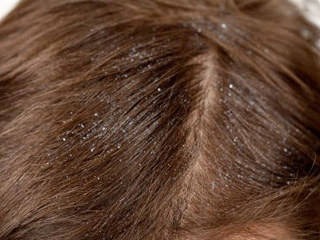 Que faire des cheveux gras, comment s'en débarrasser, prendre soin des cheveux gras à la maison. Recettes de masques