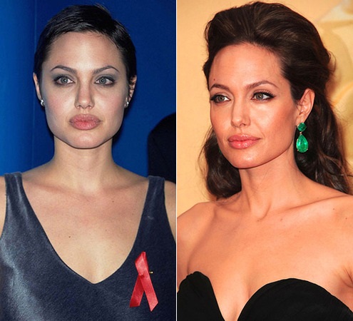 Angelina Jolie avant et après la chirurgie plastique. Une sélection de photos de l'actrice avant et après rhinoplastie, opérations de plasma-lifting