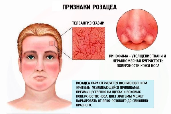 Appareil pour éliminer les taches de vieillesse, les cicatrices, les tatouages ​​sur le visage et la peau du corps. Laser, Fraxel, Elos, M22. Note et avis