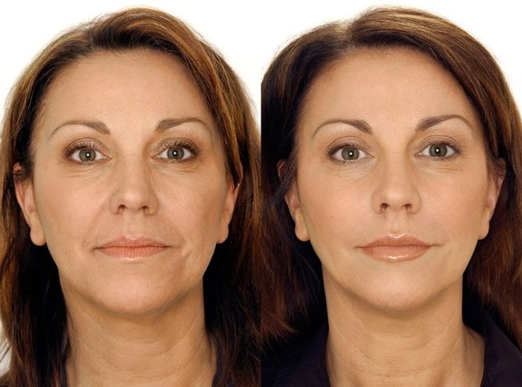 Qu'est-ce que la bio-revitalisation du visage, en quoi elle diffère de la mésothérapie, des charges. Indications, contre-indications, conséquences. Une photo