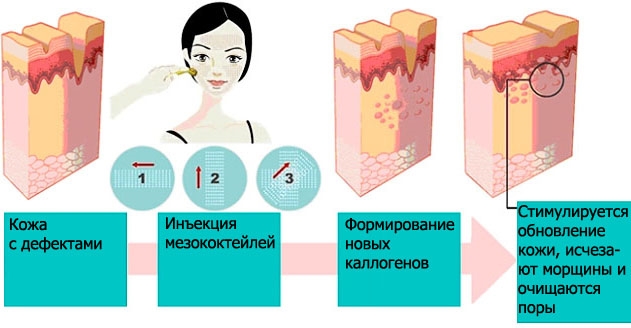 Qu'est-ce que la bio-revitalisation du visage, en quoi elle diffère de la mésothérapie, des charges. Indications, contre-indications, conséquences. Une photo