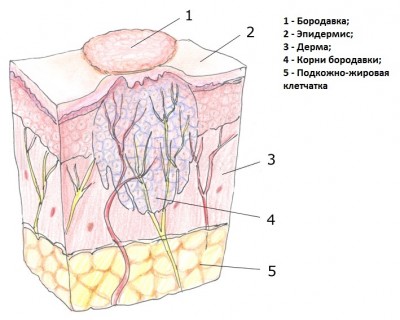 Chélidoine. Instructions d'utilisation et contre-indications. Traitement des verrues sur les mains, la plante des pieds, du cancer, des papillomes. Avis de dermatologues