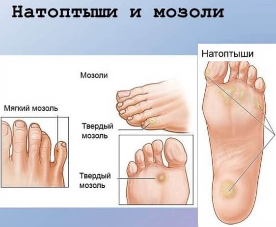 Chélidoine. Instructions d'utilisation et contre-indications. Traitement des verrues sur les mains, la plante des pieds, du cancer, des papillomes. Avis des dermatologues