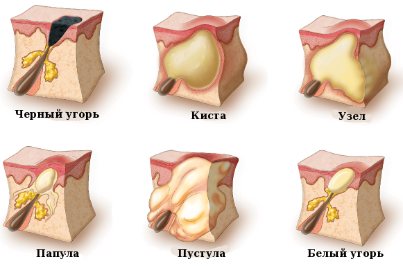 Peeling Ferul - qu'est-ce que c'est, comment est-il fait, les acides, le protocole de la procédure Medderma, les critiques, les photos et les résultats