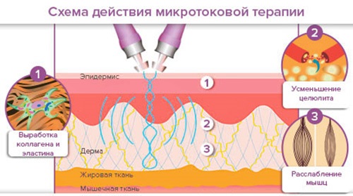 Galvanoplastie en cosmétologie - qu'est-ce que c'est, comment les procédures sont effectuées pour la peau autour des yeux, du visage et du corps, avantages et inconvénients, avantages. Appareil à usage domestique. Une photo