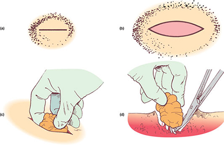 Comment se débarrasser du wen sur le visage. Onguents, crèmes, médicaments, recettes et remèdes traditionnels