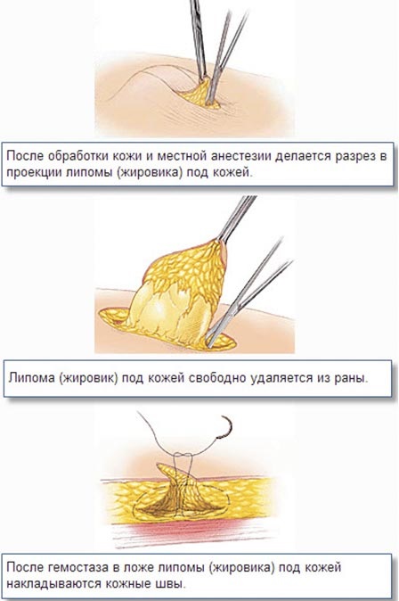 Comment se débarrasser du wen sur le visage. Onguents, crèmes, médicaments, recettes et remèdes traditionnels