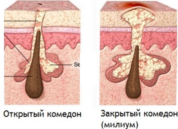 Comment se débarrasser du wen sur le visage. Onguents, crèmes, médicaments, recettes et remèdes traditionnels