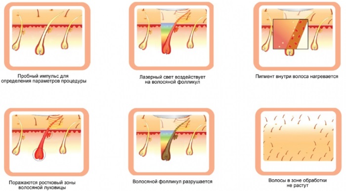 Épilation laser. Quel est le meilleur: laser à diode ou alexandrite pour le visage, le corps, la zone du bikini. Contre-indications et conséquences, résultats, photos