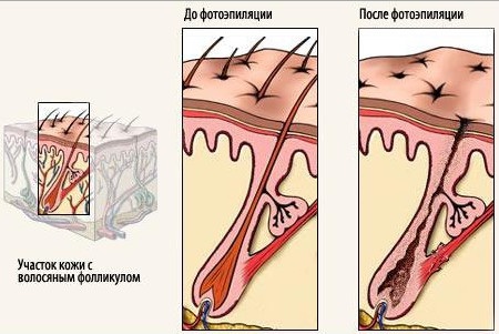 Épilation au laser pendant la grossesse et l'allaitement, tôt, tard. Est-ce possible ou non, l'avis des médecins