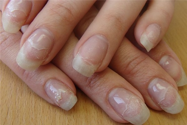 Traitement des ongles sur les mains et les pieds après vernis gel, extension. Recettes folkloriques, produits pharmaceutiques, système IBX