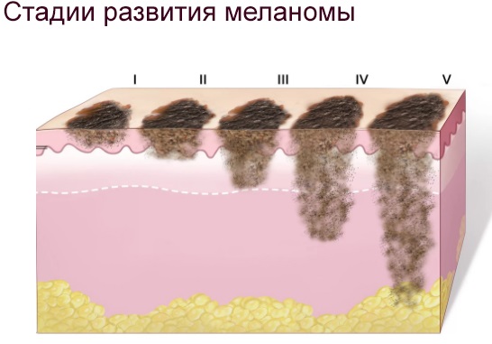 Épilation laser. Quel est le meilleur: laser à diode ou alexandrite pour le visage, le corps, la zone du bikini. Contre-indications et conséquences, résultats, photos