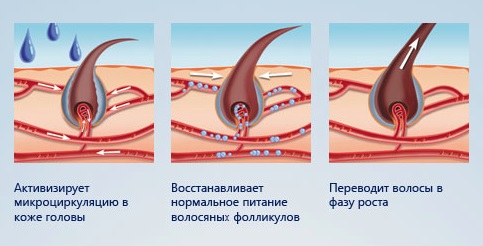 Minoxidil pour les cheveux: comment ça marche, efficacité, photos avant et après, critiques. Comment appliquer aux femmes et aux hommes, effets secondaires, dommages possibles. Prix ​​et avis