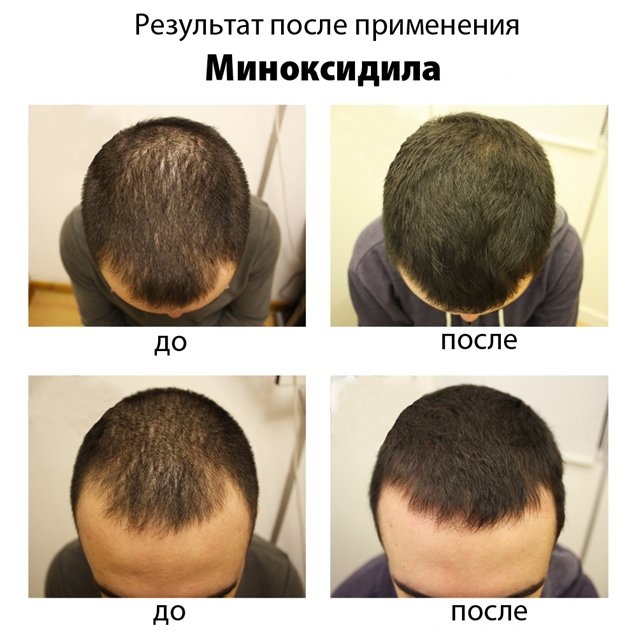 Minoxidil pour les cheveux: comment ça marche, efficacité, photos avant et après, critiques. Comment appliquer aux femmes et aux hommes, effets secondaires, dommages possibles. Prix ​​et avis